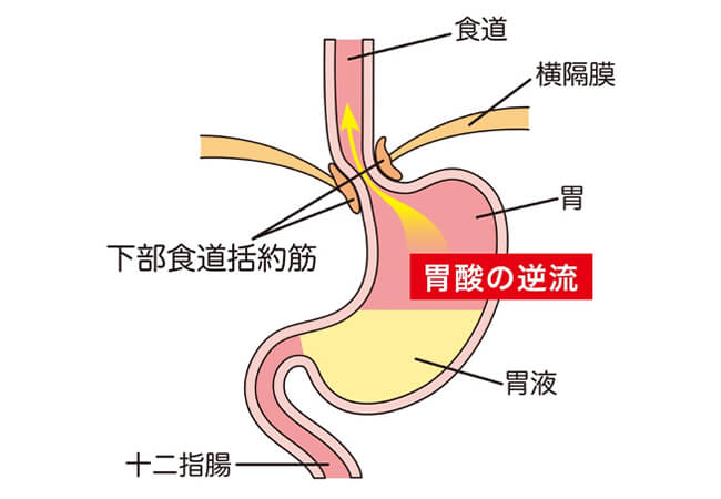 逆流性食道炎の説明図