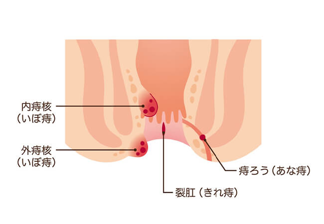 いぼの種類