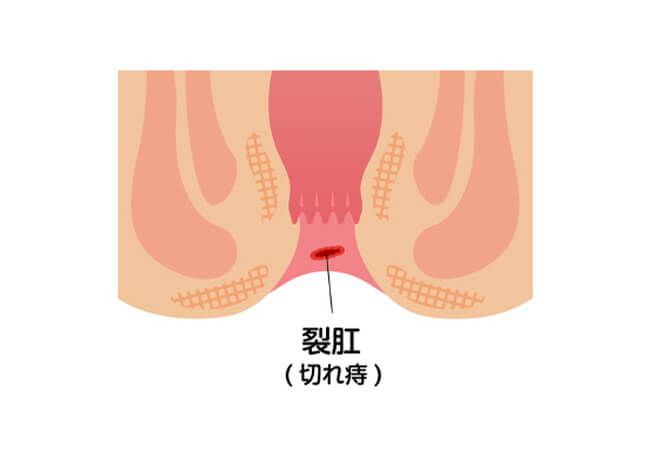 裂肛（切れ痔）のイメージ図