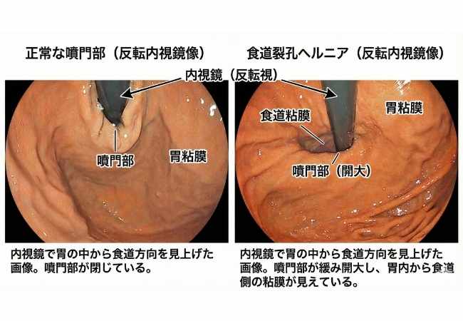 食道裂孔ヘルニア