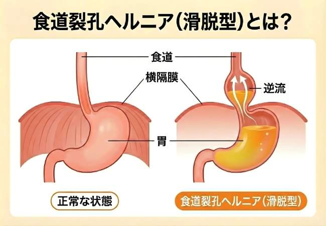 食道裂孔ヘルニア