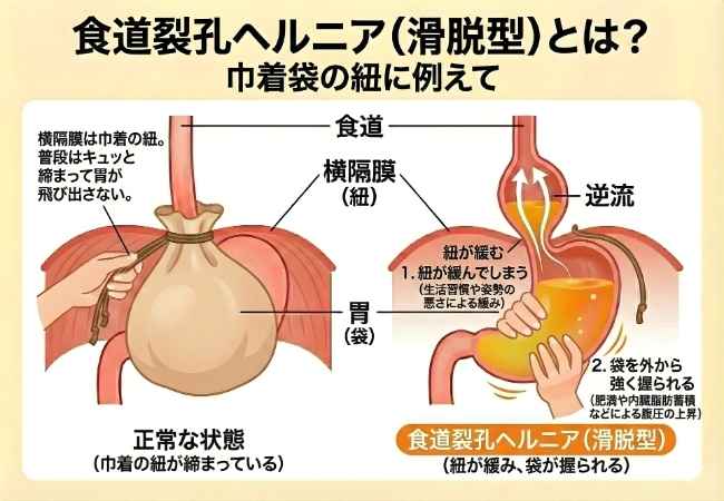 食道裂孔ヘルニア