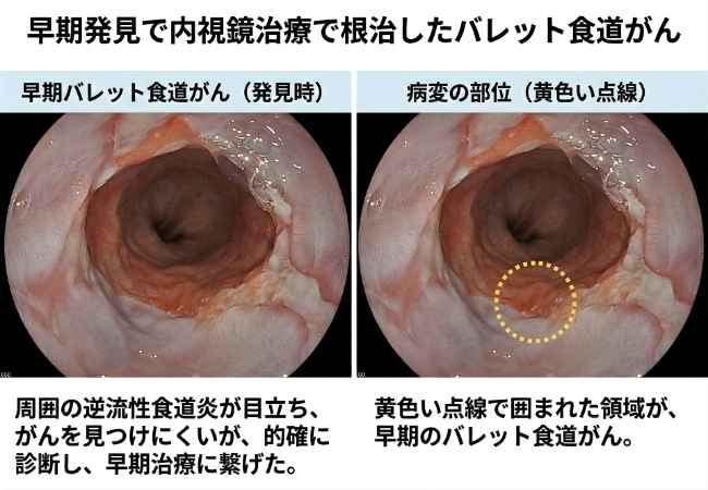 早期バレット食道がん