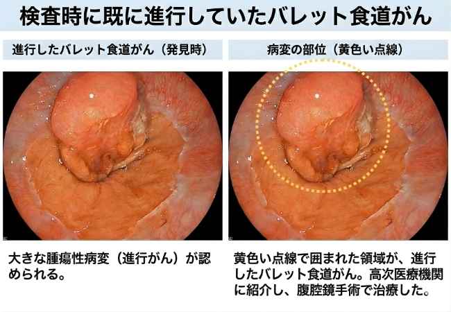 進行バレット食道がん